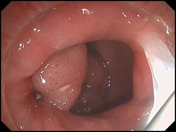 Клинические изображения SonoScape HD-350 видеоэндоскопическая система