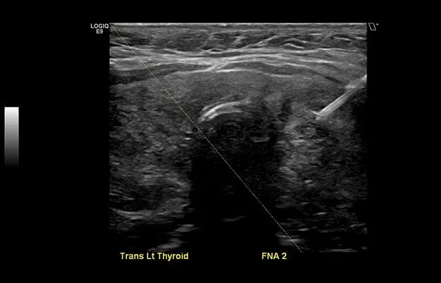 Клинические изображения УЗИ аппарат GE Healthcare Logiq E9 XDclear