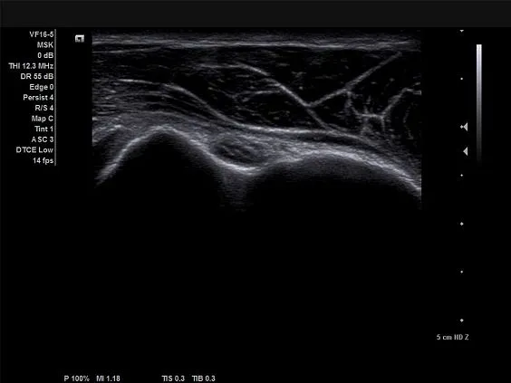 Клинические изображения Siemens Acuson X700 ультразвуковая система