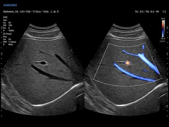V6-RUS: Печеночная вена, S-Flow