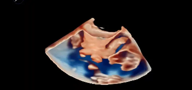 Клинические изображения Philips EPIQ CVx ультразвуковой аппарат