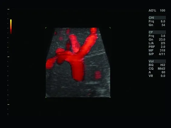 Клинические изображения Ультразвуковая диагностическая система GE Logiq S7 XDclear