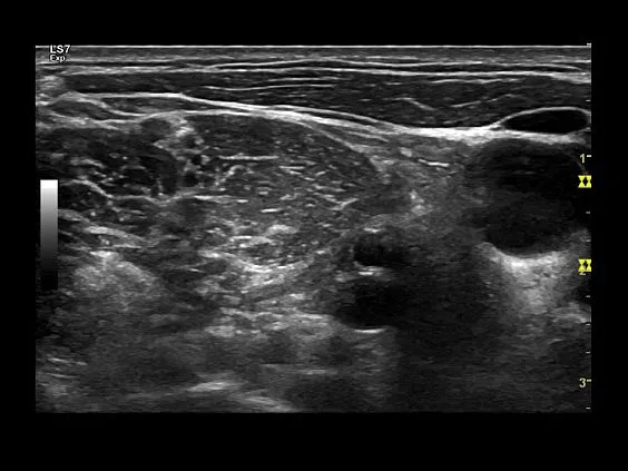 Клинические изображения Ультразвуковая диагностическая система GE Logiq S7 XDclear