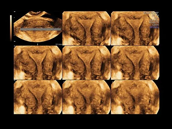 Клинические изображения GE Voluson S8 ультразвуковой аппарат