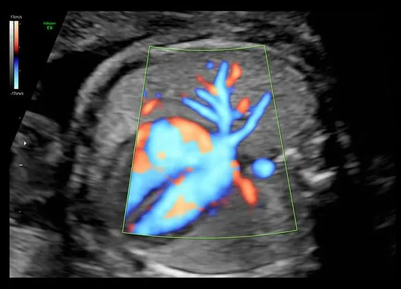 Клинические изображения Ультразвуковая диагностическая система GE HealthCare Voluson E6