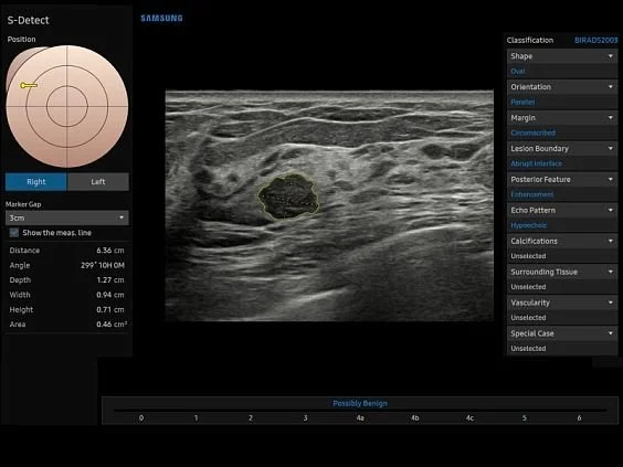 V6-RUS: Молочная железа, S-Detect