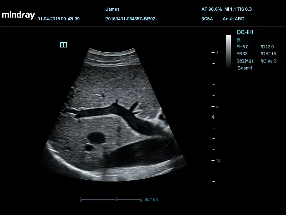 Клинические изображения УЗИ аппарат Mindray DC-60 Exp
