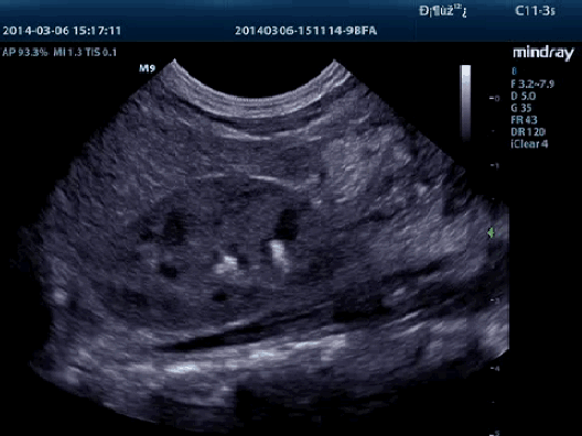 Клинические изображения УЗИ аппарат Mindray M9T портативный