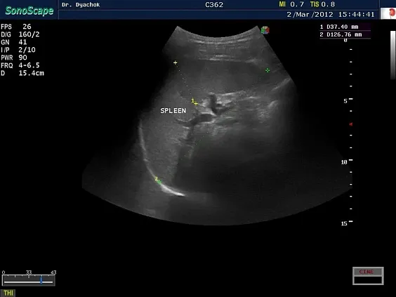 Клинические изображения Sonoscape S15 ультразвуковой аппарат