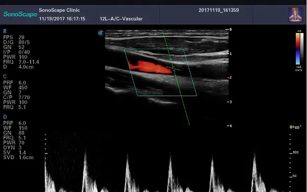 Клинические изображения Sonoscape E2 ультразвуковой аппарат