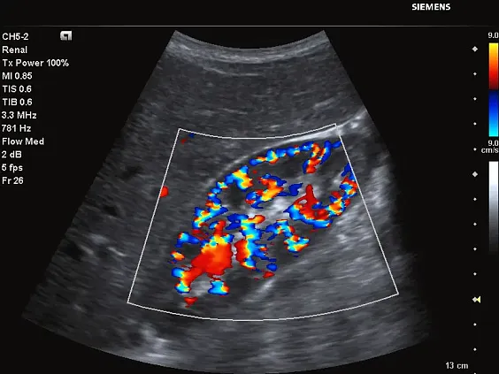 Клинические изображения Siemens Acuson P500 портативный аппарат УЗИ