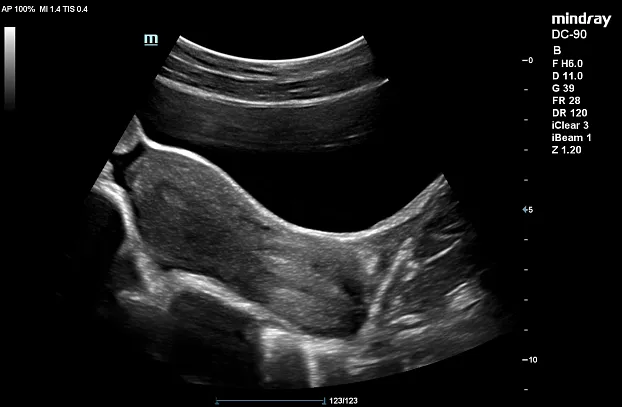 Клинические изображения УЗИ аппарат Mindray DC-90 X-Insight