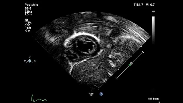 Клинические изображения Philips EPIQ Elite ультразвуковой аппарат