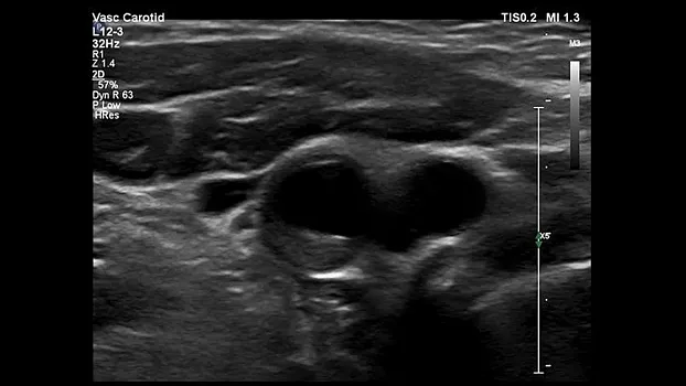 Клинические изображения Philips EPIQ Elite ультразвуковой аппарат