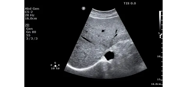 Клинические изображения Philips ClearVue 850 ультразвуковой аппарат