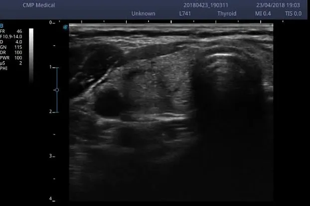 Клинические изображения Sonoscape E2 ультразвуковой аппарат