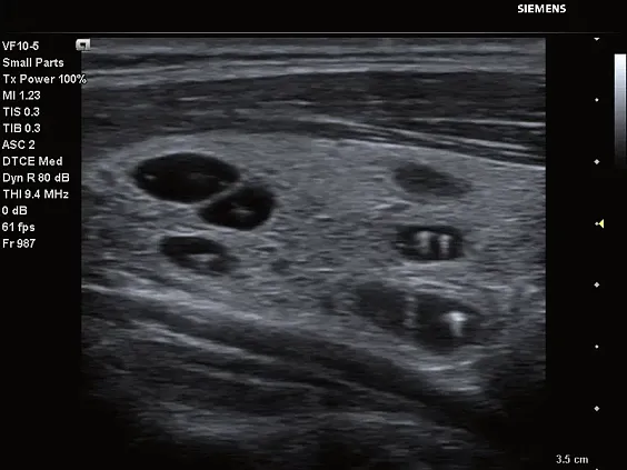 Клинические изображения Siemens Acuson P500 портативный аппарат УЗИ