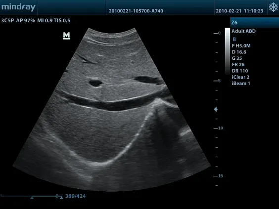 Клинические изображения УЗИ аппарат Mindray Z6 портативный