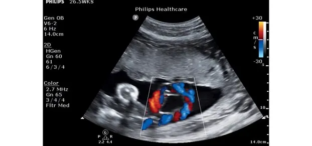 Клинические изображения Philips ClearVue 650 ультразвуковой аппарат