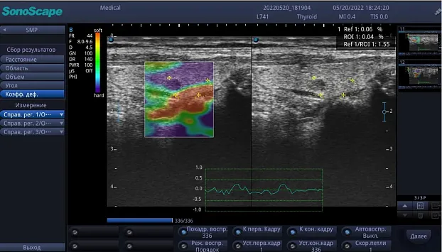 Клинические изображения Sonoscape E3 ультразвуковой аппарат