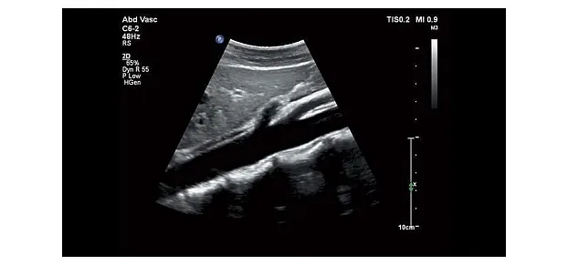 Клинические изображения Philips Affiniti 50 ультразвуковой аппарат