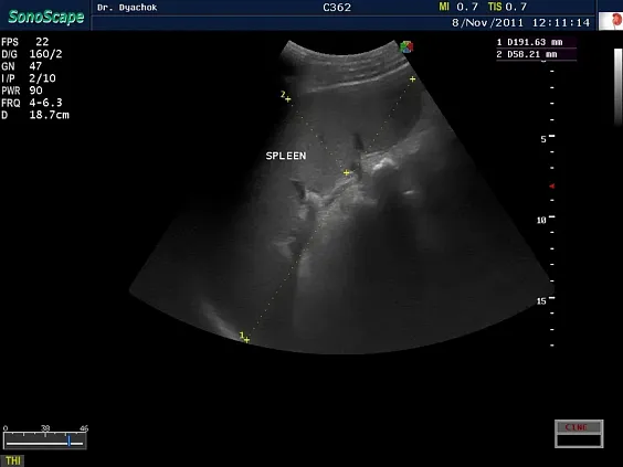Клинические изображения Sonoscape S30 ультразвуковой аппарат