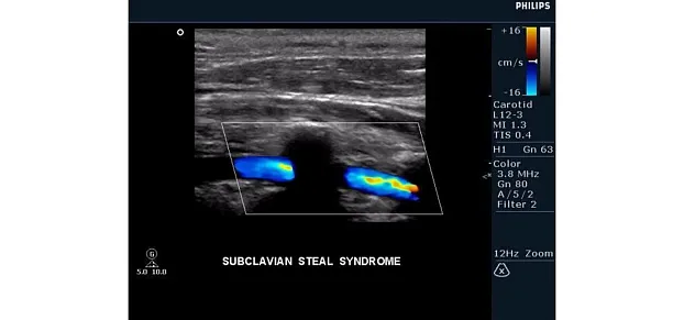 Клинические изображения Philips HD15 ультразвуковой аппарат