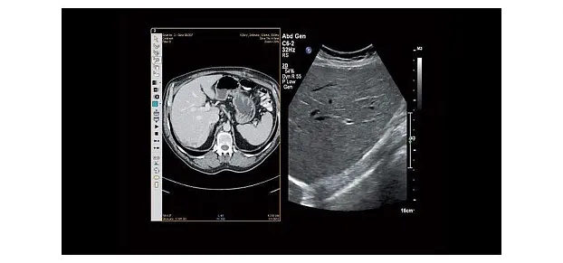 Клинические изображения Philips Affiniti 50 ультразвуковой аппарат