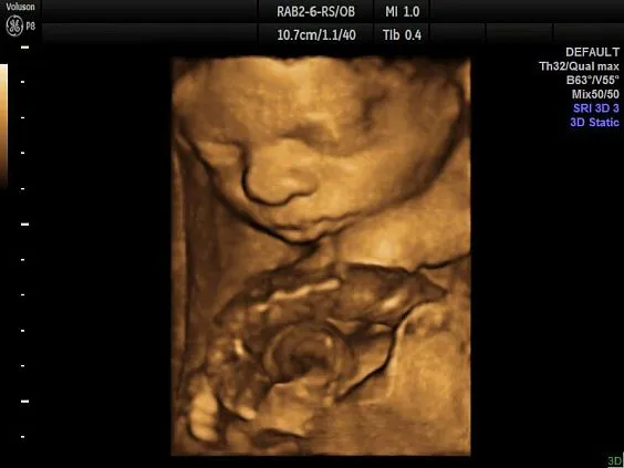 Клинические изображения УЗИ аппарат GE HealthCare Voluson P8