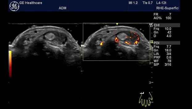 Клинические изображения Портативная ультразвуковая система GE HealthCare Logiq e